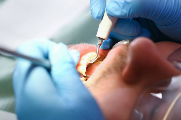Best Dental Abscess Treatment in Houghton, MI